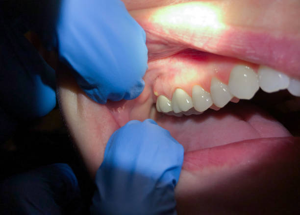 Best Knocked-Out Tooth Emergency  in Westwood Shores, TX